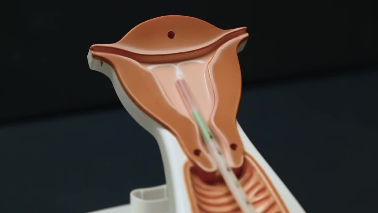 IUD insertion procedure 2024 update