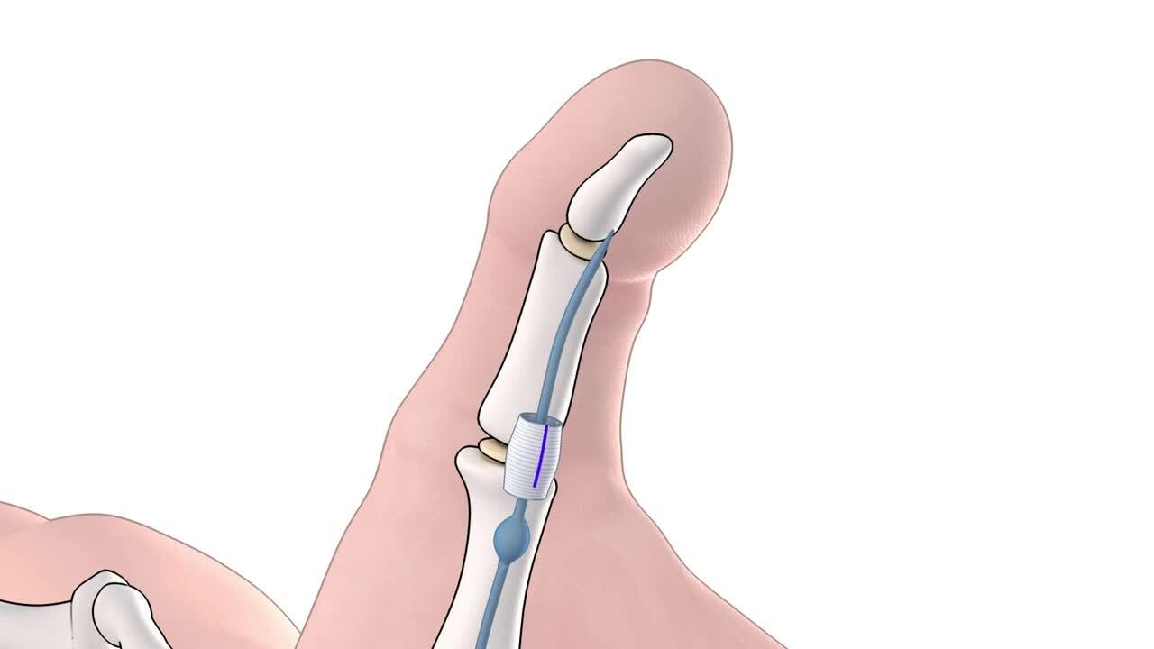 Animation shows how the thumb looks before and after trigger thumb surgery. A nodule (lump) on the tendon cannot move past the tendon pulley. Surgery opens the pulley so that the lump can move more freely and the thumb can straighten fully.