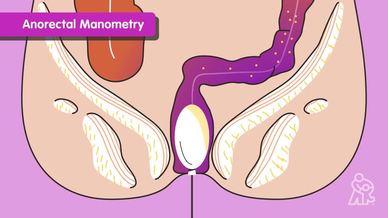 Learn more about Hirschsprung Disease from the Comprehensive Colorectal Center at Children's Mercy Kansas City. This video explains how the disease is diagnosed, as well as gives helpful information regarding treatment plans and post-surgery care. 