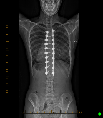 An x-ray showing a child's spine straightened with spinal fusion.