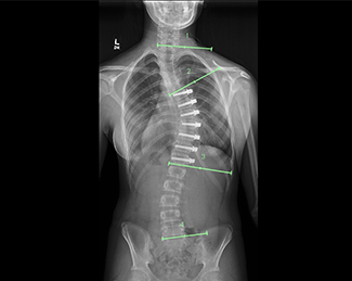 Vertebral Body Tethering | Children's Mercy Kansas City