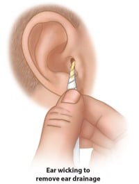 How To Properly Insert Ear Plugs - Boys Town Ear, Nose & Throat Institute 