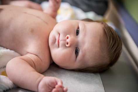 Closeup of shirtless infant with heart surgery incision scar on chest