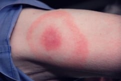 Erythema Migrans Rash