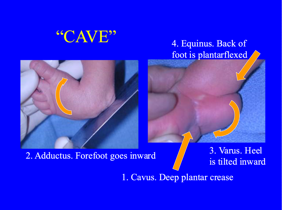 Images of an infant with clubfoot, with text that indicates diagnostic criteria of Cavus, Adductus, Varus and Equinus
