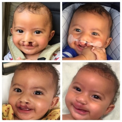 A series of 4 photos showing a smiling baby after different surgeries to correct his cleft lip.