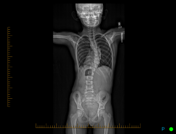 An x-ray shows a child's curved spine before a growing rod was inserted.