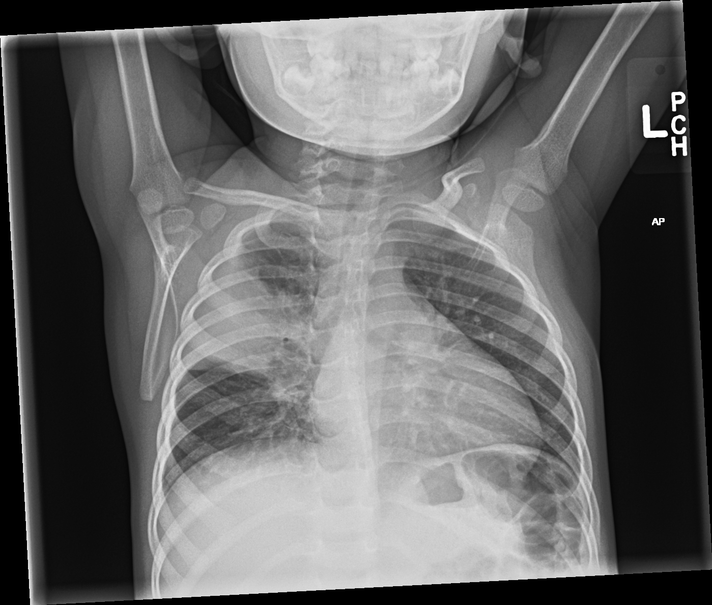 chest radiograph