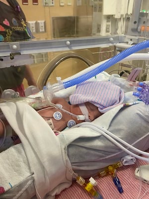 A baby sleeps in a hospital bassinet with many tubes and wires running to and from her body. The wires attached to her chest have smiley-face stickers on them. She has a soft pink and blue striped hat over her head.