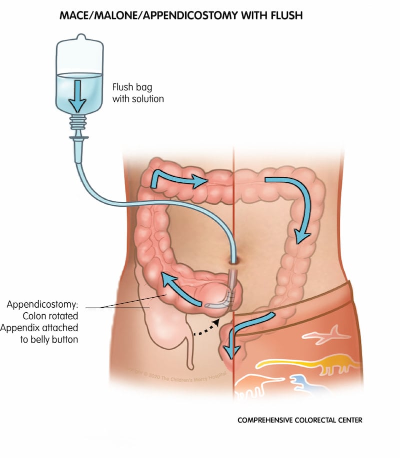 Can a Colonic Flatten Your Stomach?