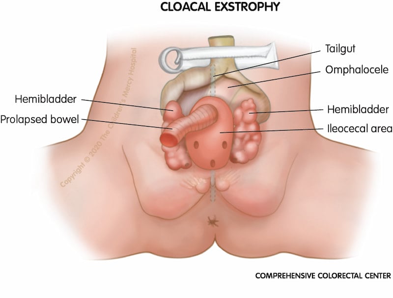 Bladder exstrophy - Symptoms and causes - Mayo Clinic