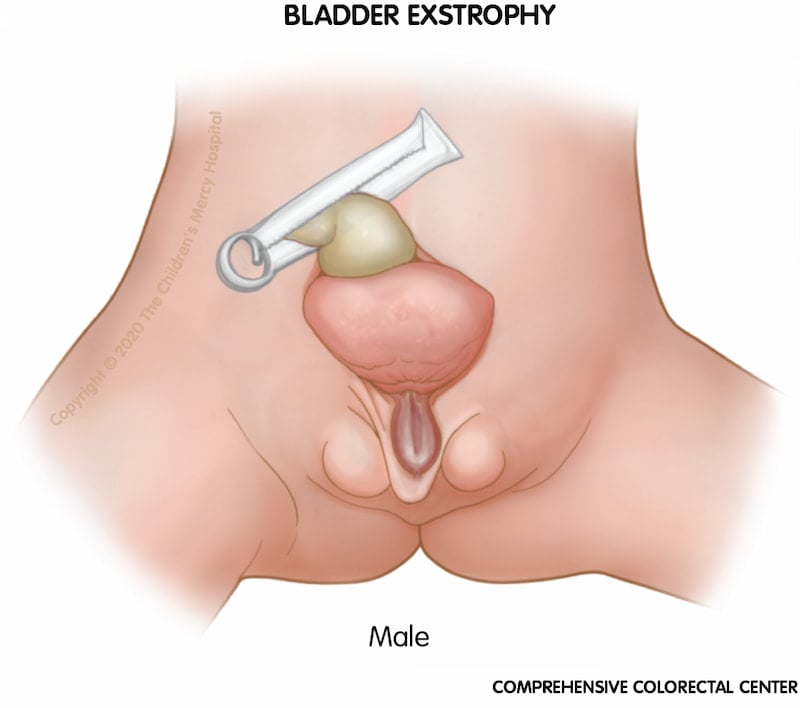 Bladder Exstrophy  Children's Hospital of Philadelphia