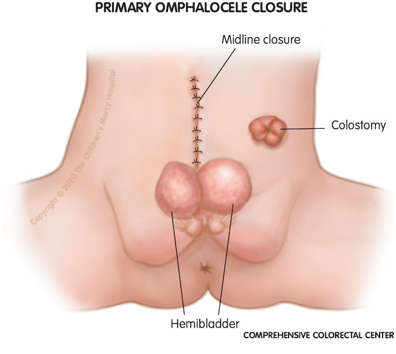 Omphalocele as component of multiple anomaly syndrome/sequence